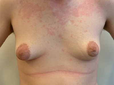 Before: Gynaecomastie