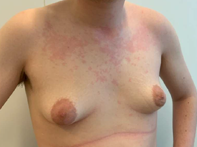Before: Gynaecomastie