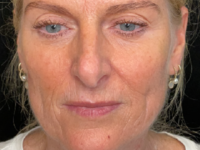 After: Skinbooster (huidtherapie)