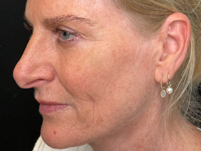 After: Skinbooster (huidtherapie)
