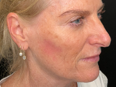 After: Skinbooster (huidtherapie)