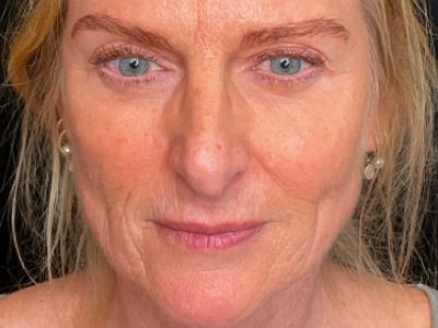 Before: Skinbooster (huidtherapie)
