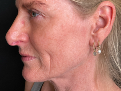 Before: Skinbooster (huidtherapie)