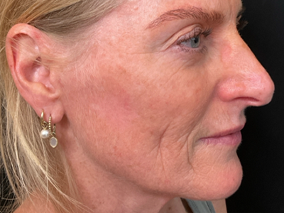 Before: Skinbooster (huidtherapie)