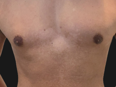 After: Gynaecomastie