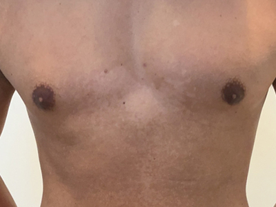 After: Gynaecomastie