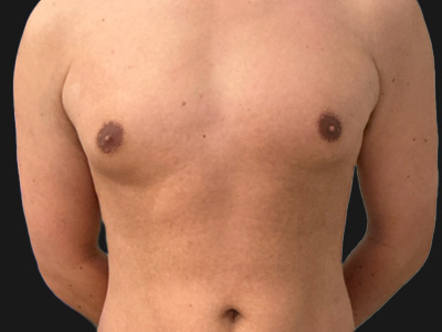 Before: Gynaecomastie