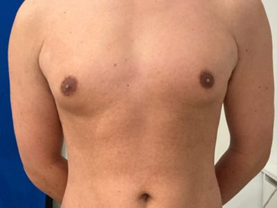 Before: Gynaecomastie
