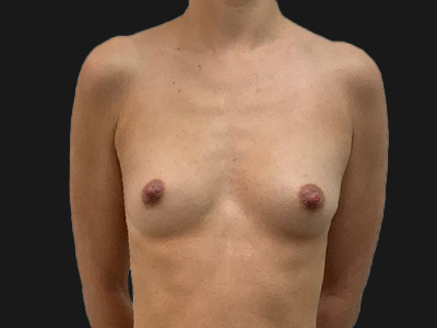 Before: Lipofilling borsten