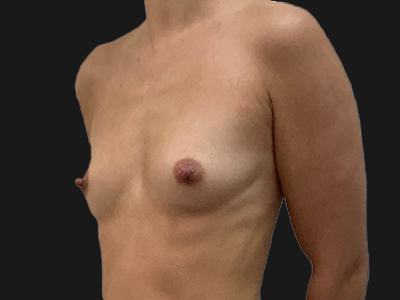 Before: Lipofilling borsten