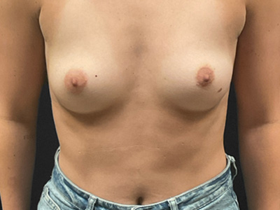 Before: Borstvergroting