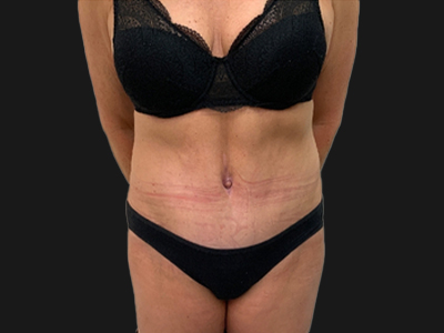 After: Buikwandcorrectie