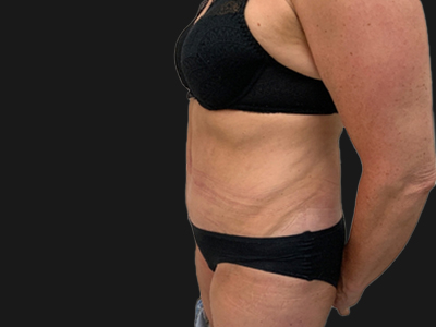 After: Buikwandcorrectie