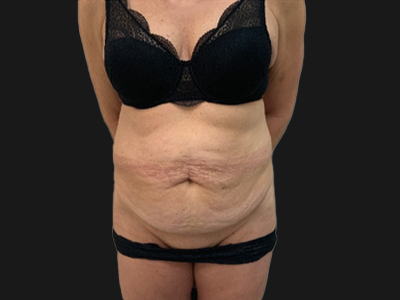 Before: Buikwandcorrectie