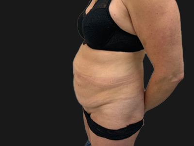Before: Buikwandcorrectie