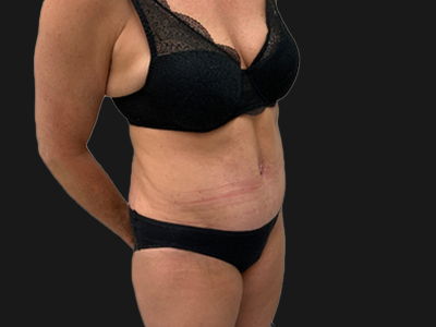 After: Buikwandcorrectie