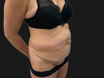 Before: Buikwandcorrectie