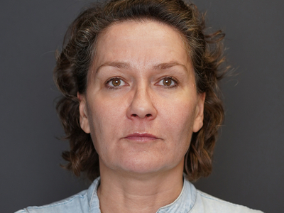 After: Fillers