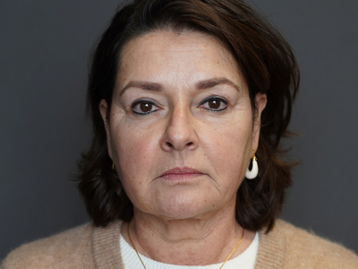 After: Fillers