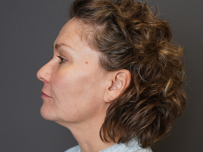 After: Fillers