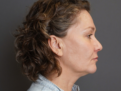 After: Fillers