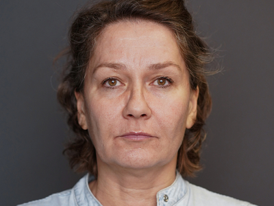 Before: Fillers