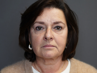 Before: Fillers