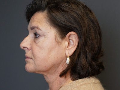 Before: Fillers