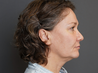 Before: Fillers