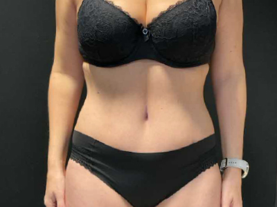 After: Buikwandcorrectie