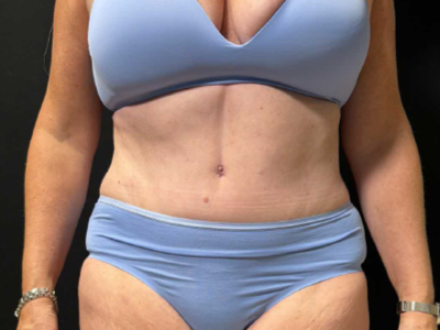 After: Buikwandcorrectie