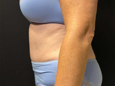 After: Buikwandcorrectie