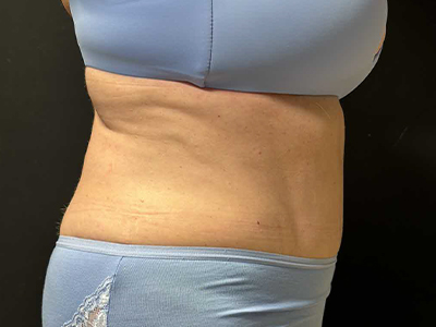 After: Buikwandcorrectie