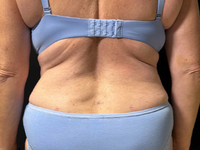 After: Buikwandcorrectie