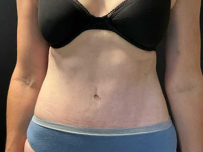 After: Buikwandcorrectie