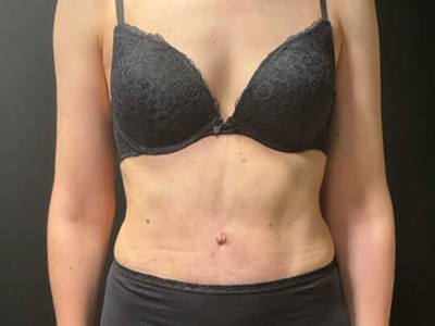 After: Buikwandcorrectie