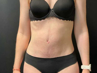After: Rectus Diastase