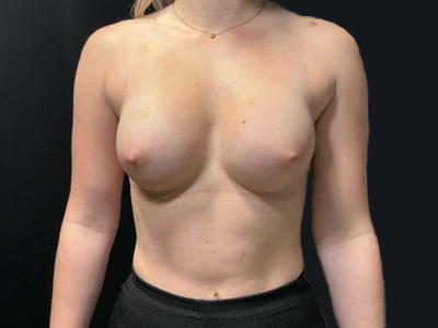 After: Borstvergroting