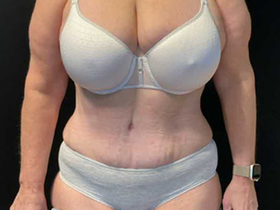 After: Buikwandcorrectie