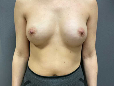 After: Borstvergroting