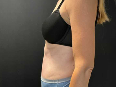After: Buikwandcorrectie