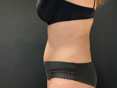 After: Buikwandcorrectie