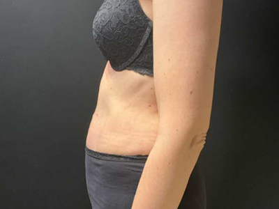 After: Buikwandcorrectie