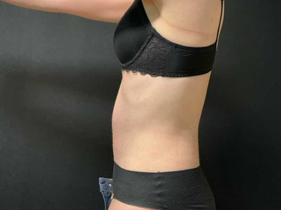 After: Rectus Diastase