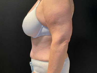 After: Buikwandcorrectie