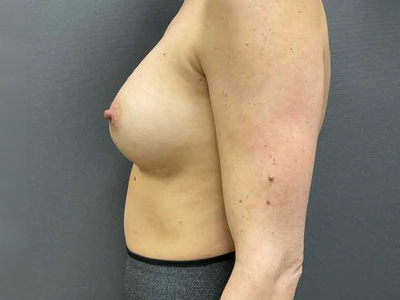 After: Borstvergroting