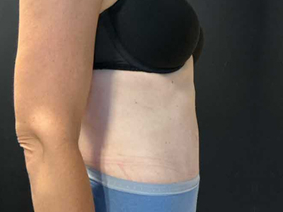 After: Buikwandcorrectie