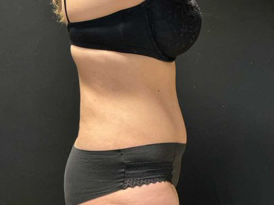 After: Buikwandcorrectie