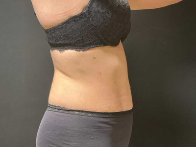 After: Buikwandcorrectie