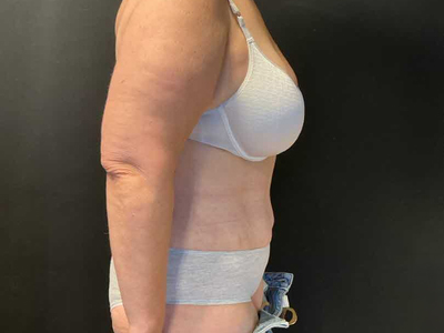 After: Buikwandcorrectie